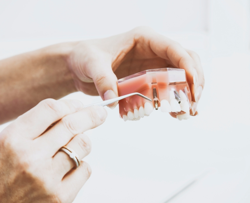 Implantes dentales en Barcelona